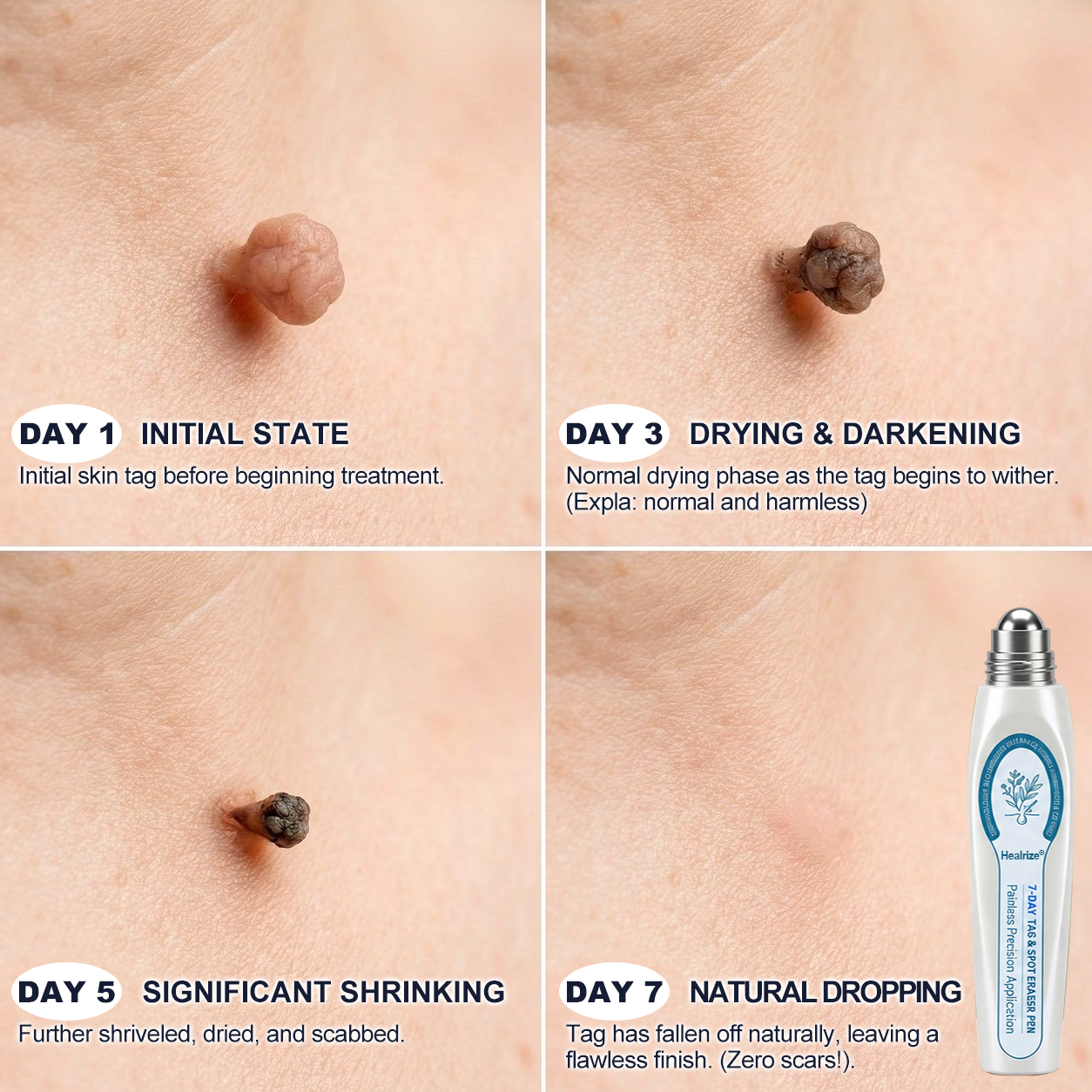 𝐇e𝐚𝐥𝐫i𝐳e® 7-𝐷𝑎𝑦 𝗧𝐚𝐠 & 𝗦𝗽𝐨𝐭 𝐄𝐫𝒂𝒔𝒆𝒓(Zero Pain, Zero 𝐒𝐜𝐚𝒓𝒔 Rollerball)💝