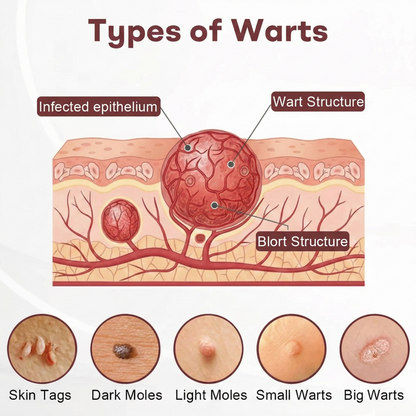🇮🇪 Made and Shipped from Ireland  ✅Awzlove® Wart &Mole Removal All-in-One Cream🏆